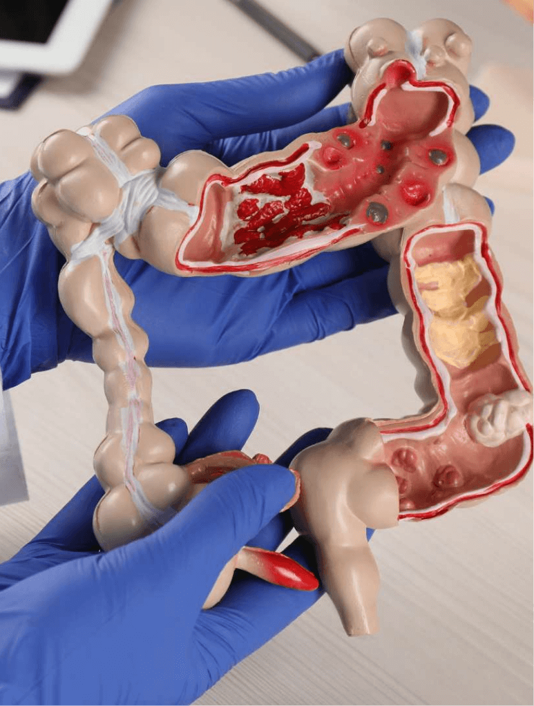 Representacion de coloproctología